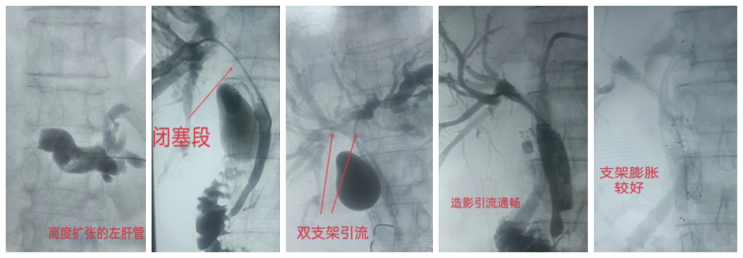 胆管支架什么样子我院独立成功开展高位胆管梗阻双支架置入引流_https://www.jmylbn.com_新闻资讯_第3张