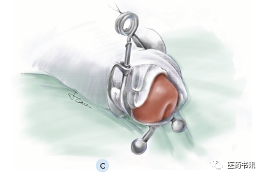 膀胱镜检查需要哪些器械当医学遇上美术｜膀胱镜检查准备_https://www.jmylbn.com_新闻资讯_第11张