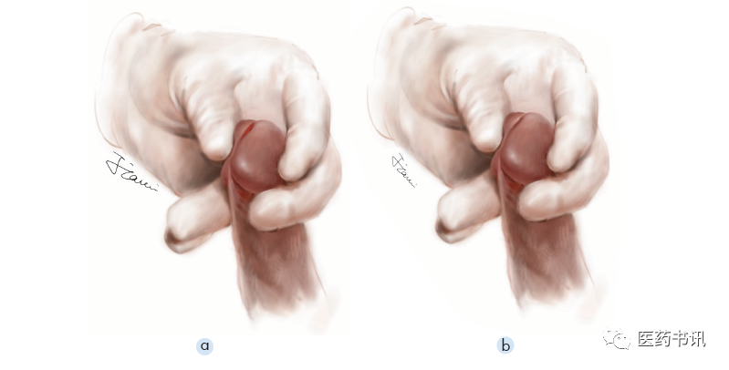 膀胱镜检查需要哪些器械当医学遇上美术｜膀胱镜检查准备_https://www.jmylbn.com_新闻资讯_第9张