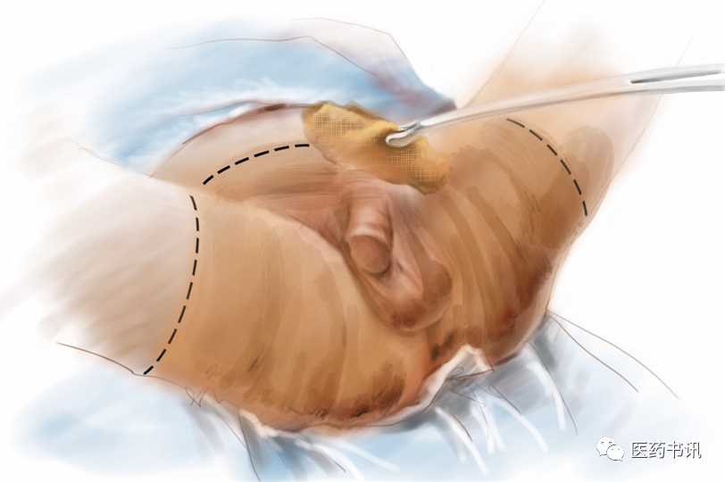 膀胱镜检查需要哪些器械当医学遇上美术｜膀胱镜检查准备_https://www.jmylbn.com_新闻资讯_第6张