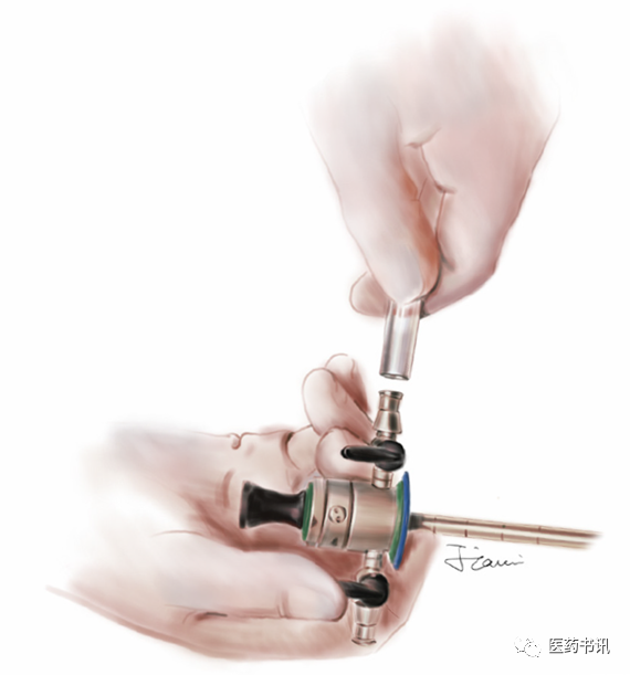 膀胱器械都有哪些图片当医学遇上美术｜硬性膀胱镜_https://www.jmylbn.com_新闻资讯_第12张