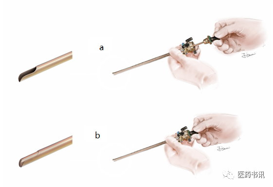 膀胱器械都有哪些图片当医学遇上美术｜硬性膀胱镜_https://www.jmylbn.com_新闻资讯_第4张