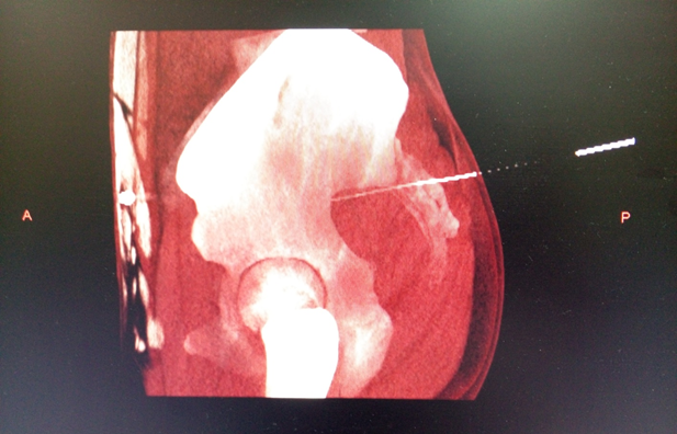 悄悄告诉你的他秩边透水道针法拯救这种男性常见病