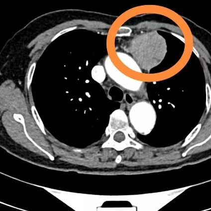 外科拉勾怎么拉“天平拉钩”！医生的“第三只手”搞定这一肿瘤_https://www.jmylbn.com_新闻资讯_第2张