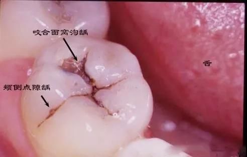 当后牙出现黑线，牙齿已“亮起红灯”