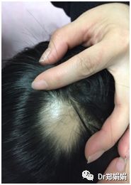 推拿治疗小儿斑秃案例分享