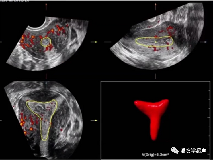 彩超怎么设置频率子宫内膜容受性彩超检查_https://www.jmylbn.com_新闻资讯_第2张