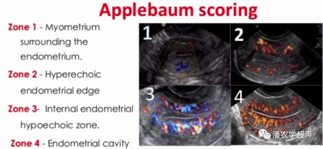 彩超怎么设置频率子宫内膜容受性彩超检查_https://www.jmylbn.com_新闻资讯_第3张