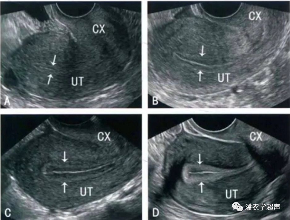 彩超怎么设置频率子宫内膜容受性彩超检查_https://www.jmylbn.com_新闻资讯_第1张