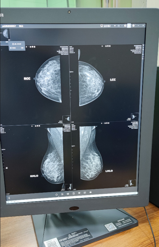 什么乳腺机钨靶机--乳腺癌诊断的好帮手！_https://www.jmylbn.com_新闻资讯_第14张