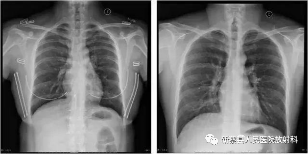 X光拍片为什么要等拍X光片的四种常见误区_https://www.jmylbn.com_新闻资讯_第5张