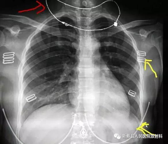 X光拍片为什么要等拍X光片的四种常见误区_https://www.jmylbn.com_新闻资讯_第2张