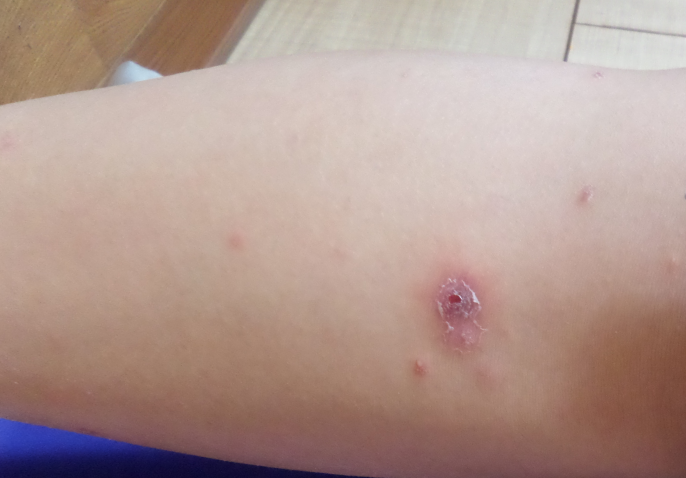 螨虫病的症状图片图库_螨虫疹图片和症状图片_被螨虫咬的症状图片