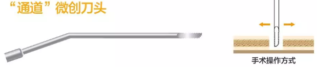 超声吸引刀是什么东劢推荐：《超声刀4——大盘点：国内超声刀汇总研究，重点企业各有所长》_https://www.jmylbn.com_新闻资讯_第17张