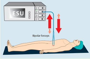 为什么手术用电刀东劢推荐：高频电外科设备2——高频电刀如何取代手术刀？从技术发展、组成原理到市场分析_https://www.jmylbn.com_新闻资讯_第3张