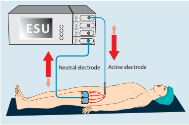 为什么手术用电刀东劢推荐：高频电外科设备2——高频电刀如何取代手术刀？从技术发展、组成原理到市场分析_https://www.jmylbn.com_新闻资讯_第2张