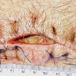 爱孚贴什么伤囗可以用伤口恢复快，感染率低！这几款湿性愈合敷料了解一下~_https://www.jmylbn.com_新闻资讯_第5张