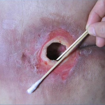 爱孚贴什么伤囗可以用伤口恢复快，感染率低！这几款湿性愈合敷料了解一下~_https://www.jmylbn.com_新闻资讯_第4张