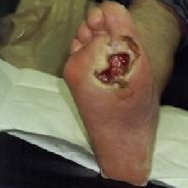 爱孚贴什么伤囗可以用伤口恢复快，感染率低！这几款湿性愈合敷料了解一下~_https://www.jmylbn.com_新闻资讯_第6张