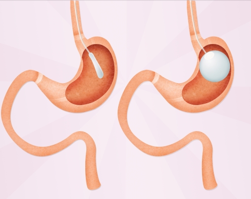 球囊是什么医疗器械减肥医疗器械：人工智能可吞咽减肥球囊技术进展_https://www.jmylbn.com_新闻资讯_第3张