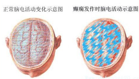日本光电脑电图怎么样脑生物电活动的记录者——脑电图_https://www.jmylbn.com_新闻资讯_第6张