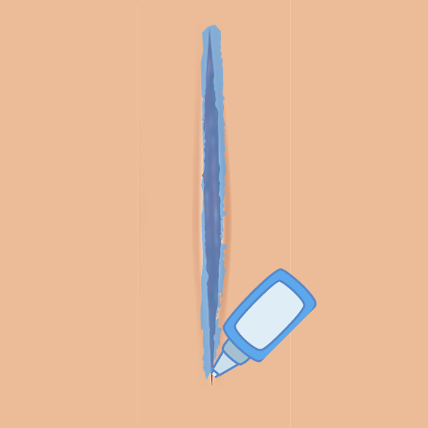 为什么要用皮钉缝合外伤后不想留疤？4 种闭合创口方式哪个更好？_https://www.jmylbn.com_新闻资讯_第4张