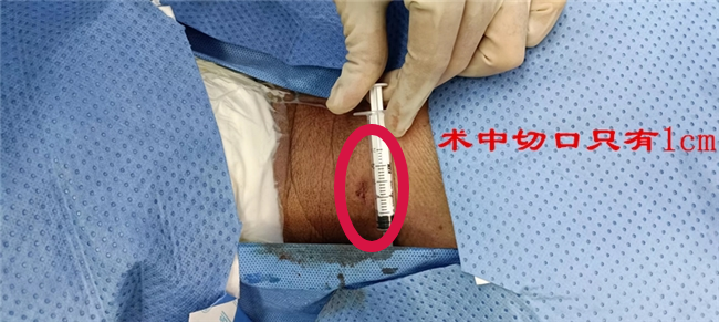 开刀孔怎么开刀技术 ｜ 不开刀用镜子做手术！小小“钥匙孔”解决患者大痛苦_https://www.jmylbn.com_新闻资讯_第5张