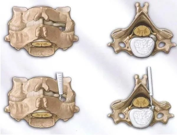 开刀孔怎么开刀技术 ｜ 不开刀用镜子做手术！小小“钥匙孔”解决患者大痛苦_https://www.jmylbn.com_新闻资讯_第3张