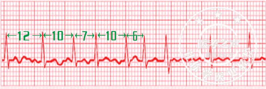 心电监护怎么看图图文并茂最全心电图，值得转发收藏_https://www.jmylbn.com_新闻资讯_第7张