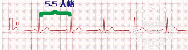 心电监护怎么看图图文并茂最全心电图，值得转发收藏_https://www.jmylbn.com_新闻资讯_第11张
