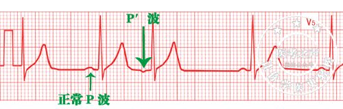 心电监护怎么看图图文并茂最全心电图，值得转发收藏_https://www.jmylbn.com_新闻资讯_第12张