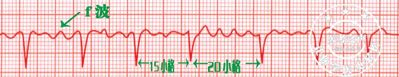 心电监护怎么看图图文并茂最全心电图，值得转发收藏_https://www.jmylbn.com_新闻资讯_第16张