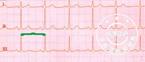 心电监护怎么看图图文并茂最全心电图，值得转发收藏_https://www.jmylbn.com_新闻资讯_第6张