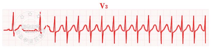 学习心电图，这是我见过最完美的文章！