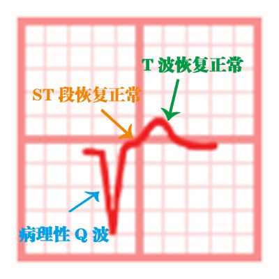 学习心电图，这是我见过最完美的文章！