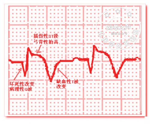 心电监护怎么看图图文并茂最全心电图，值得转发收藏_https://www.jmylbn.com_新闻资讯_第58张