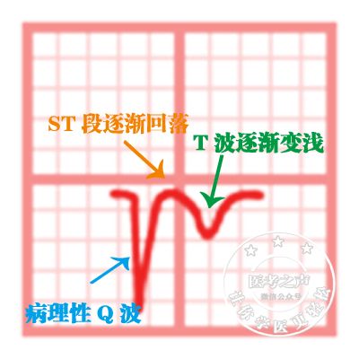 学习心电图，这是我见过最完美的文章！