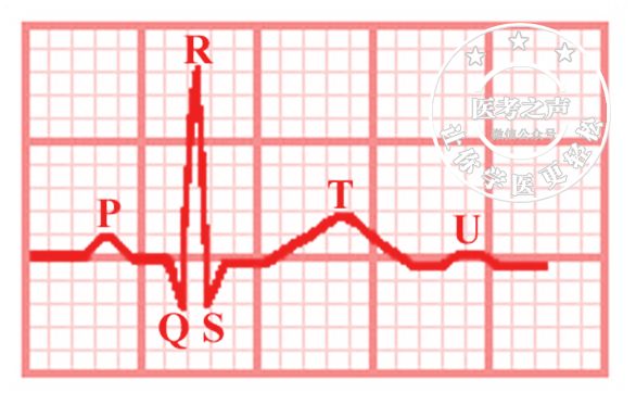 心电监护怎么看图图文并茂最全心电图，值得转发收藏_https://www.jmylbn.com_新闻资讯_第46张