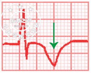 学习心电图，这是我见过最完美的文章！