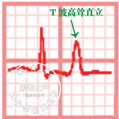 心电监护怎么看图图文并茂最全心电图，值得转发收藏_https://www.jmylbn.com_新闻资讯_第47张