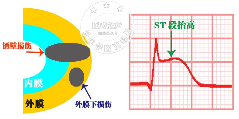心电监护怎么看图图文并茂最全心电图，值得转发收藏_https://www.jmylbn.com_新闻资讯_第55张