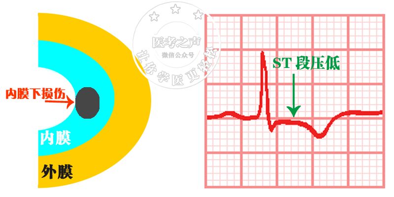 心电监护怎么看图图文并茂最全心电图，值得转发收藏_https://www.jmylbn.com_新闻资讯_第53张