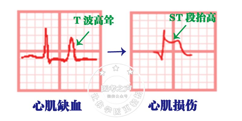 心电监护怎么看图图文并茂最全心电图，值得转发收藏_https://www.jmylbn.com_新闻资讯_第59张