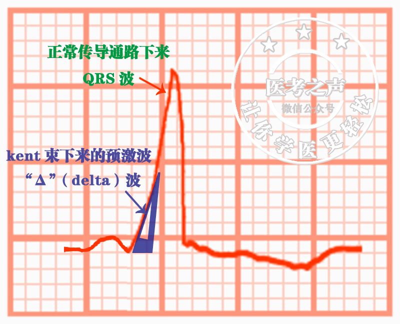 心电监护怎么看图图文并茂最全心电图，值得转发收藏_https://www.jmylbn.com_新闻资讯_第44张