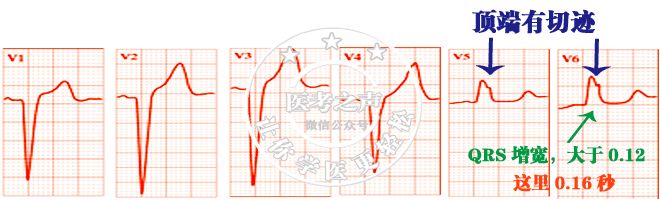 心电监护怎么看图图文并茂最全心电图，值得转发收藏_https://www.jmylbn.com_新闻资讯_第31张