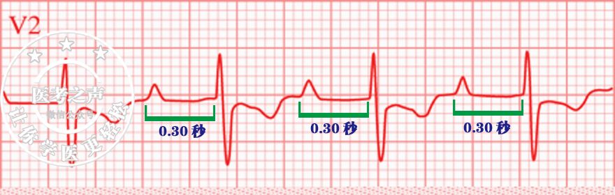 心电监护怎么看图图文并茂最全心电图，值得转发收藏_https://www.jmylbn.com_新闻资讯_第26张
