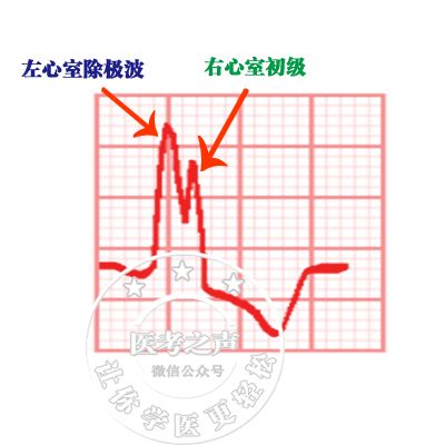 心电监护怎么看图图文并茂最全心电图，值得转发收藏_https://www.jmylbn.com_新闻资讯_第35张