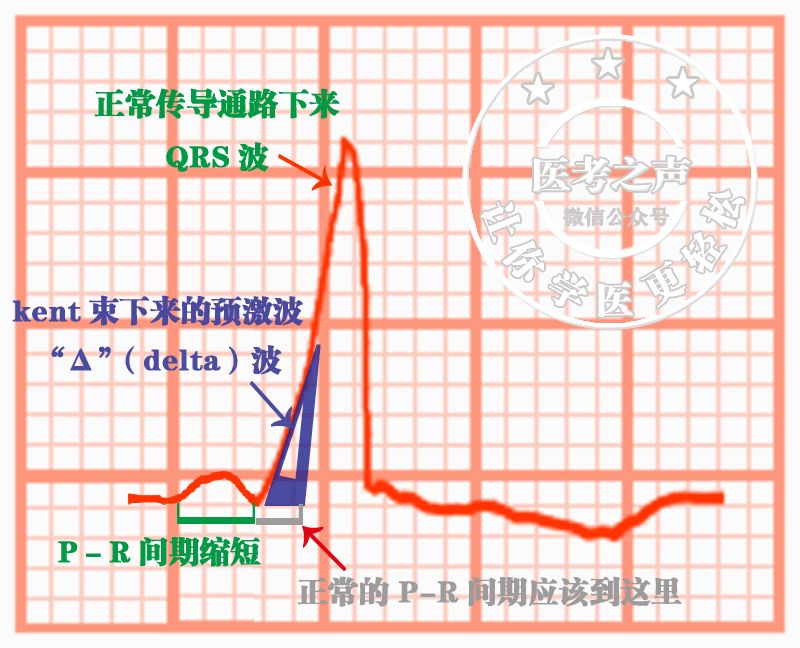 心电监护怎么看图图文并茂最全心电图，值得转发收藏_https://www.jmylbn.com_新闻资讯_第42张
