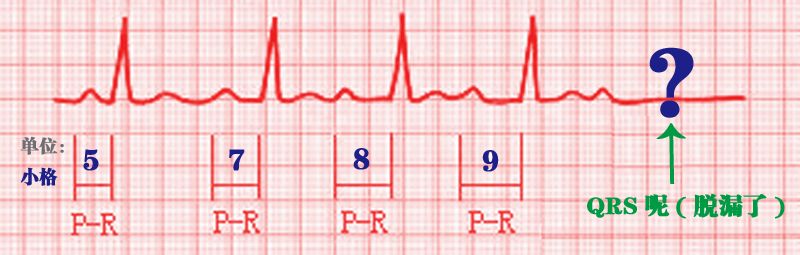 心电监护怎么看图图文并茂最全心电图，值得转发收藏_https://www.jmylbn.com_新闻资讯_第27张