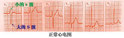 心电监护怎么看图图文并茂最全心电图，值得转发收藏_https://www.jmylbn.com_新闻资讯_第37张